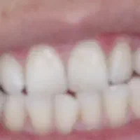 پودر دندان زغالی  سفید کننده و جرمگیر ۱۰۰٪ گیاهی