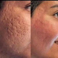 خال برداری کاملا بهداشتی وباوسایل یک بار مصرف|خدمات آرایشگری و زیبایی|قم, امامزاده ابراهیم|دیوار