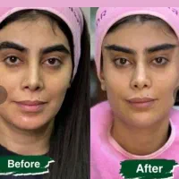 بلفارو/غبغب/سانترال/چشم گربه ایی/فیلر بادی و بکینی|خدمات آرایشگری و زیبایی|اهواز, کیانپارس |دیوار