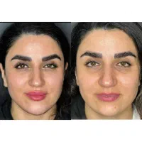 تزریق فیلر و بوتاکس در کلینیک پوست و لیزر سهرابی|خدمات آرایشگری و زیبایی|کرمانشاه, |دیوار