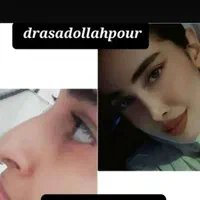 جراحی زیبایی بینی فقط با 22 ملیون|خدمات آرایشگری و زیبایی|شاهرود, |دیوار