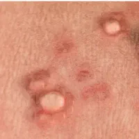 درمان اچ پی وی واچ آی وی وزگیل تناسلی|آرایشی، بهداشتی، درمانی|تهران, شهرک چیتگر|دیوار