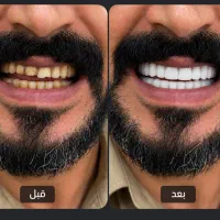 دندان مصنوعی قرارداد آنلاین با کلیه بیمه ها