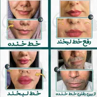 بوتاکس فیلر(ژل) مزوتراپی، پی ار پی درمطب گلسار رشت|خدمات آرایشگری و زیبایی|رشت, گلسار|دیوار