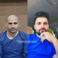 کاشت مو پرتراکم