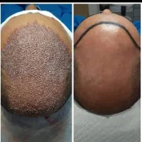 کاشت موی طبیعی -بازگشت اعتماد بنفس شما در یک جلسه|خدمات آرایشگری و زیبایی|یزد, |دیوار