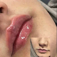 ژل لب تزریق ژل بوتاکس ژل گونه چانه زاویه فک|خدمات آرایشگری و زیبایی|اصفهان, سعادت‌آباد|دیوار