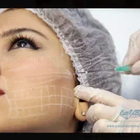 آموزش لیفت صورت با نخ