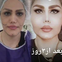 ساکشن(تخلیه) و تزریق بدن و صورت تخصصی در کلینیک|خدمات آرایشگری و زیبایی|اهواز, کیانپارس |دیوار