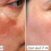 تزریق مزوژل روشن‌کننده جوانساز وبوتاکس|خدمات آرایشگری و زیبایی|آبادان, |دیوار