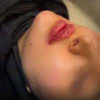 فیلر لب بوتاکس بلفاروپلاستی تخلیه غبغب مزوتراپی