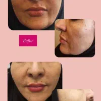 لیفت با نخ|خدمات آرایشگری و زیبایی|اصفهان, باغ زیار|دیوار