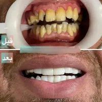 اف ویژه زیبایی کامپوزیت دندان و درمانی