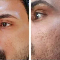 کرم جلادهنده  پوست