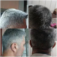 رفع سفیدی وریزش موی سر