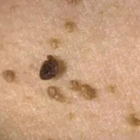 Hpv بهبود و پاکسازی زیگیل