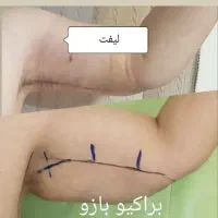 تخفیفات ویژه لیپوماتیک و ابدو و اسلیو اقساطی|خدمات آرایشگری و زیبایی|تهران, میدان ولیعصر|دیوار