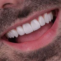 کامپوزیت/ایمپلنت/دندانپزشکی/تخفیف و اقساط پنج ساله