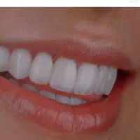 تخفیف ویژه عصب‌کشی2790 ترمیم و کشیدن دندان