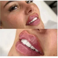 لیزر خانم آقا،ژل،بوتاکس،هایفو،لاغری