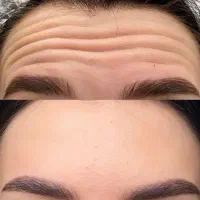 بوتاکس تخصصی صورت‌ و زیربغل