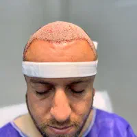 کاشت مو ، ریش ، ابرو|خدمات آرایشگری و زیبایی|شیراز, معالی‌آباد|دیوار