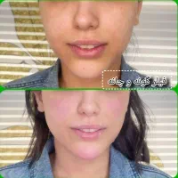 جشنواره تخفیفات ژل و بوتاکس|خدمات آرایشگری و زیبایی|نجف‌آباد, امام خمینی|دیوار