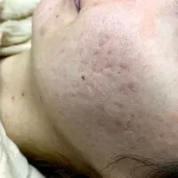 سابسیژن بافت اسکار