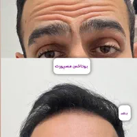 تزریق ژل بوتاکس لیزر فیلر فیشال پاک کردن تاتو|خدمات آرایشگری و زیبایی|قدس, شهر‌قدس|دیوار