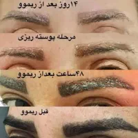 پاک کردن تاتوقدیمی ابرو دریک مرحله تضمینی با رجوی
