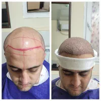 مدل کاشت مو