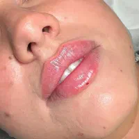 آموزش ژل و بوتاکس