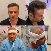 کاشت مو و ابرو به روش شیرازی با گارانتی کتبی