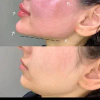 جشنواره ژل بوتاکس.فیلرلیفت نخ.بوتاکس.انزیم.پی ارپی|خدمات آرایشگری و زیبایی|مشهد, سناباد|دیوار