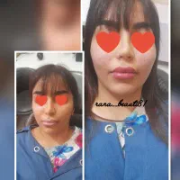 ژل و بوتاکس