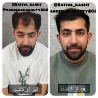 «کاشت مو برای آقایان و بانوان در تهران»