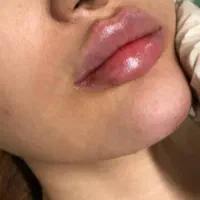 تزریق ژل و بوتاکس و کاشت نخ و مزوژل های جوان ساز|خدمات آرایشگری و زیبایی|شیراز, ابیوردی|دیوار