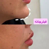 تزریق ژل وبوتاکس تخفیف ویژه|خدمات آرایشگری و زیبایی|تهران, خانی آباد نو شمالی|دیوار