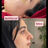 جراحی بینی با تخفیف استثنایی به مدت ۱۰روز|خدمات آرایشگری و زیبایی|بندرعباس, |دیوار