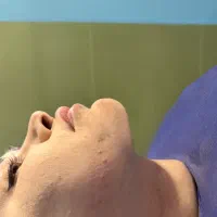 میکرو کاشت ابرو و ساکشن غبغب