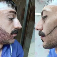 کاشت ریش طبیعی با شرایط اقساطی|خدمات زیبایی و سلامت|تبریز, |دیوار