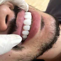 کامپوزیت دندان اف ویژه