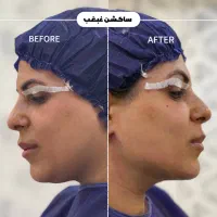 ساکشن غبغب/تزریق چربی/بلفاروپلاستی توسط متخصص