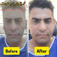 جشنواره ساکشن تخصصی غبغب و تزریق چربی اقساط|خدمات آرایشگری و زیبایی|تهران, شهر زیبا|دیوار