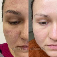 پاکسازی پوست درمان جوش جای جوش لک و کک ومک|خدمات آرایشگری و زیبایی|اصفهان, ملک‌شهر|دیوار