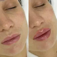 مدل فیلر کل صورت ،ژل لب، چونه،گونه،زاویه فک|خدمات آرایشگری و زیبایی|مشهد, هنرستان|دیوار