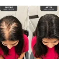 پک معجزه آسا رویش مجددمو باعملکردسلول بنیادی