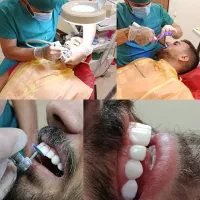 زیبایی دندان فقط با ۷ میلیون/کامپوزیت