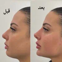 تزریق ژل بوتاکس ساکشن غبغب نخ لیفت توسط پزشک|خدمات آرایشگری و زیبایی|کرج, گلشهر|دیوار
