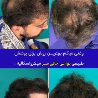 رفع کمپشتی مو با تکنیک میکرو اسکالپ /مکمل کاشتمو|خدمات آرایشگری و زیبایی|مشهد, احمدآباد|دیوار